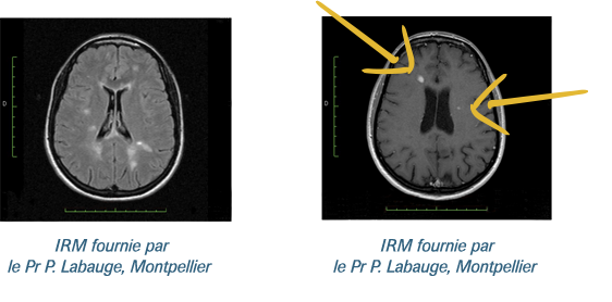IRM Médullaire Sclérose en Plaques - Lumière sur la SEP
